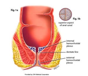 anatomy of hemorrhoid image showing the distinction between internal and external hemorrhoids