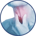 difficulty-swallowing